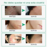 Crema-de-rebote-de-la-piel-sin-cicatrices-crema-facial-para-eliminar-cicatrices-de-acn-estr.webp